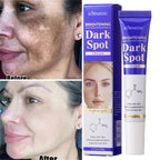 Dark Spots Removal Cream Facial Whitening Freckle Acne Mark Pigmentation Removal Melanin Skin Correction Brighten Care Products